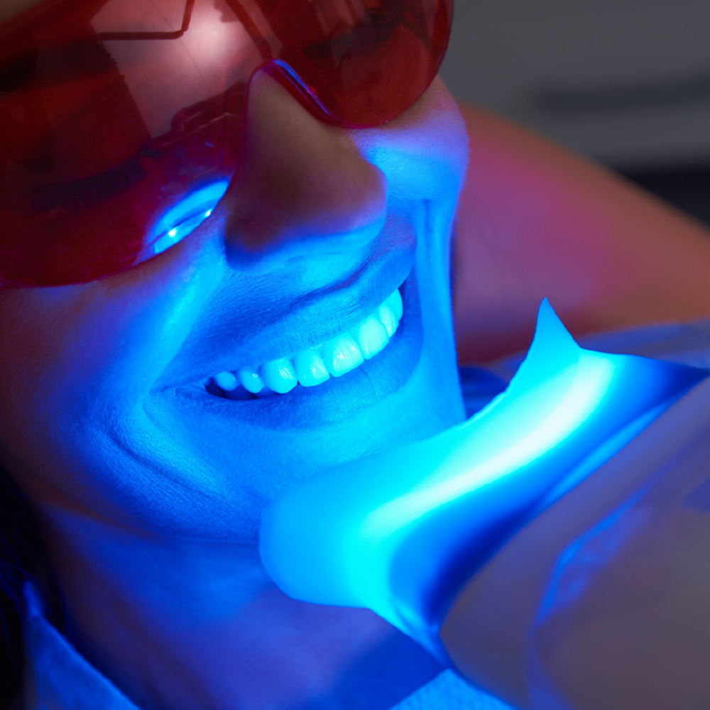 Teeth Whitening